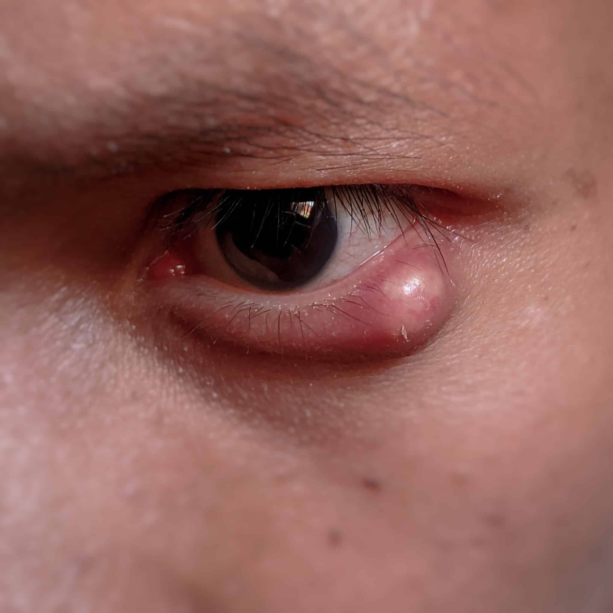 Stye Treatment Manhattan | Hordeolum Medical Therapy Bronx, NY