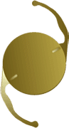 Toric Lens Implant